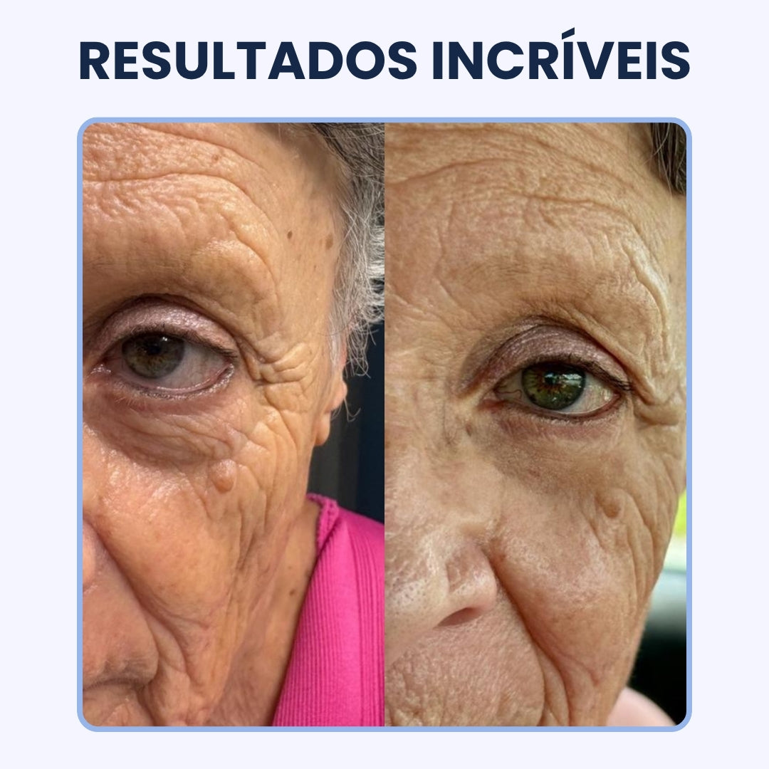 CREME PARA OLHEIRAS E PAPOS | 100% de eficácia | OpenEyes™ (2 + 1 GRÁTIS)