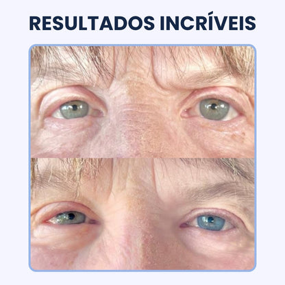 CREME PARA OLHEIRAS E PAPOS | 100% de eficácia | OpenEyes™ (2 + 1 GRÁTIS)