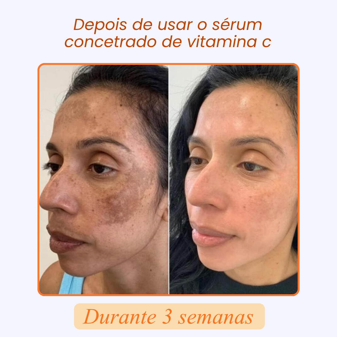 SÉRUM CONCENTRADO de VITAMINA C, COLAGÉNIO e ÁCIDO HIALURÓNICO | SKIN C SERUM™ (1 + 2 GRÁTIS)