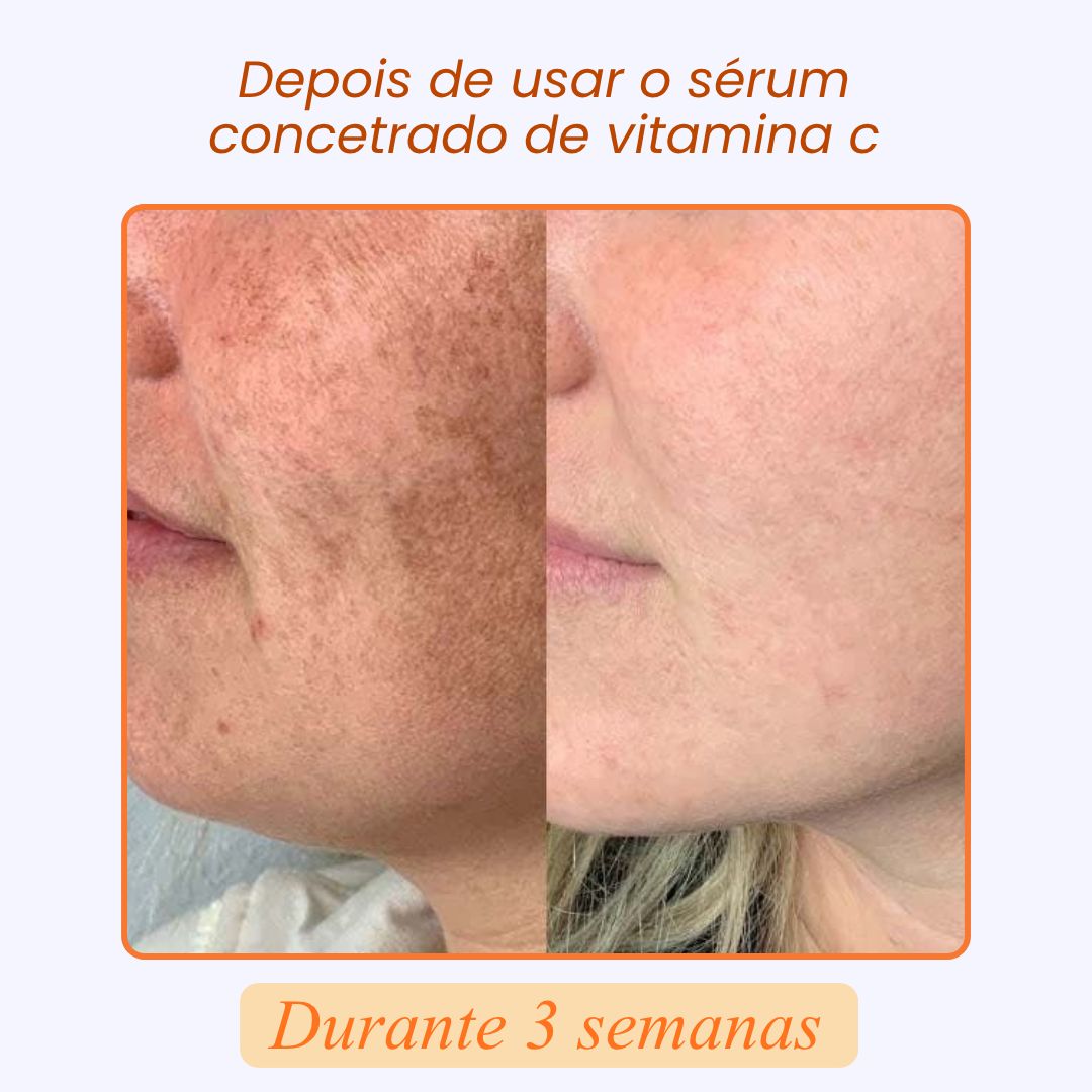 SÉRUM CONCENTRADO de VITAMINA C, COLAGÉNIO e ÁCIDO HIALURÓNICO | SKIN C SERUM™ (1 + 2 GRÁTIS)